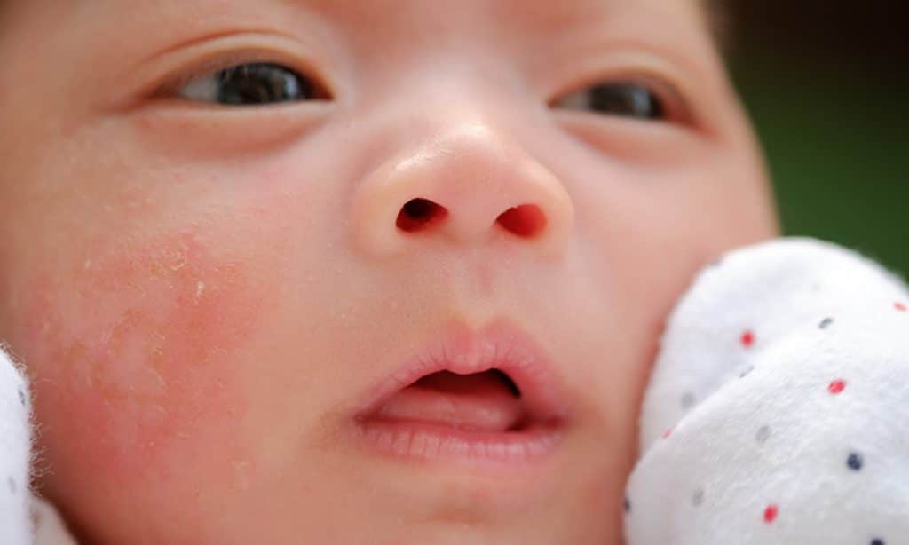 Zo herken je baby acne
